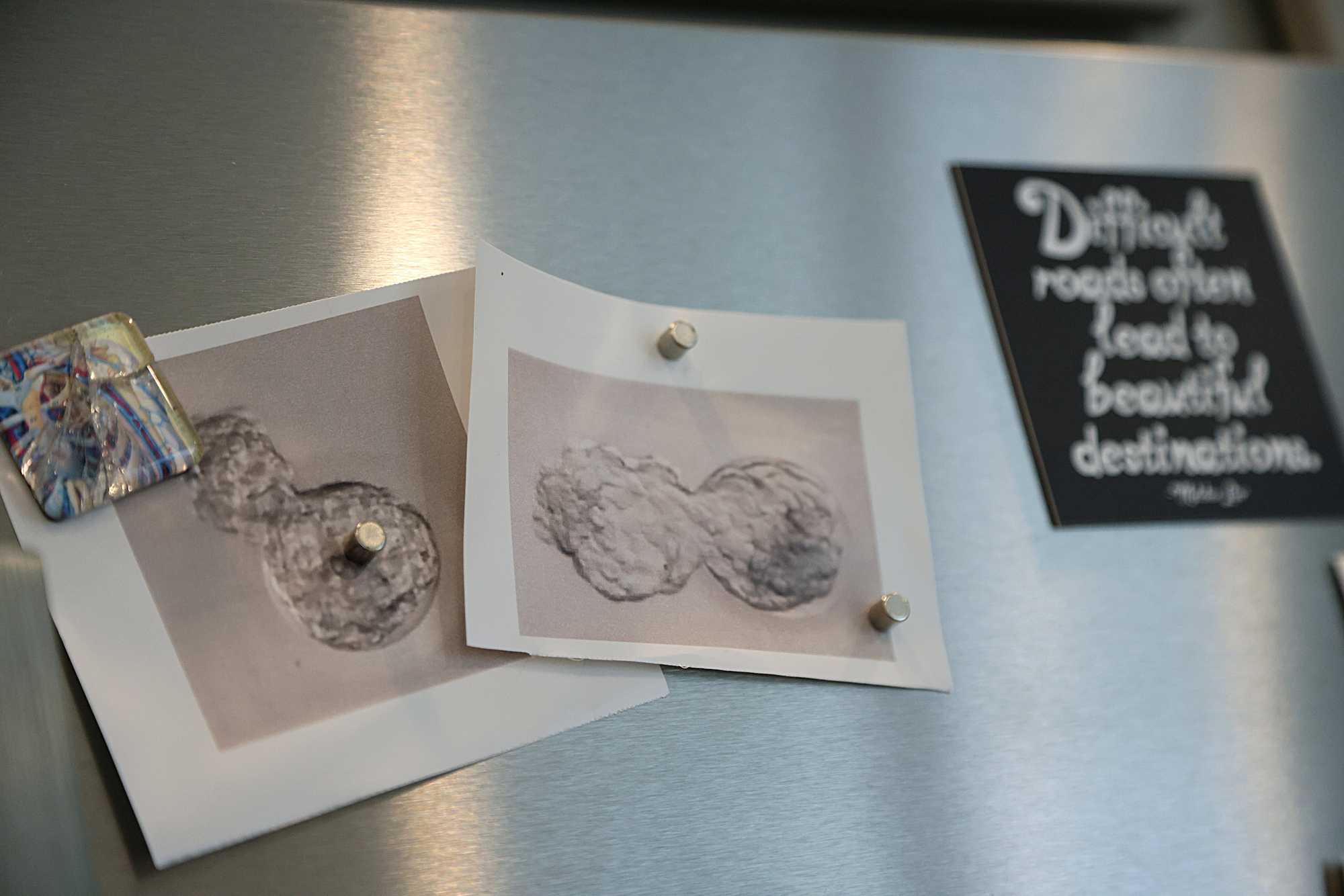 A photograph of Dr. Jamie Adler’s daughter, Coco, when she was an embryo on the day of transfer to a surrogate.